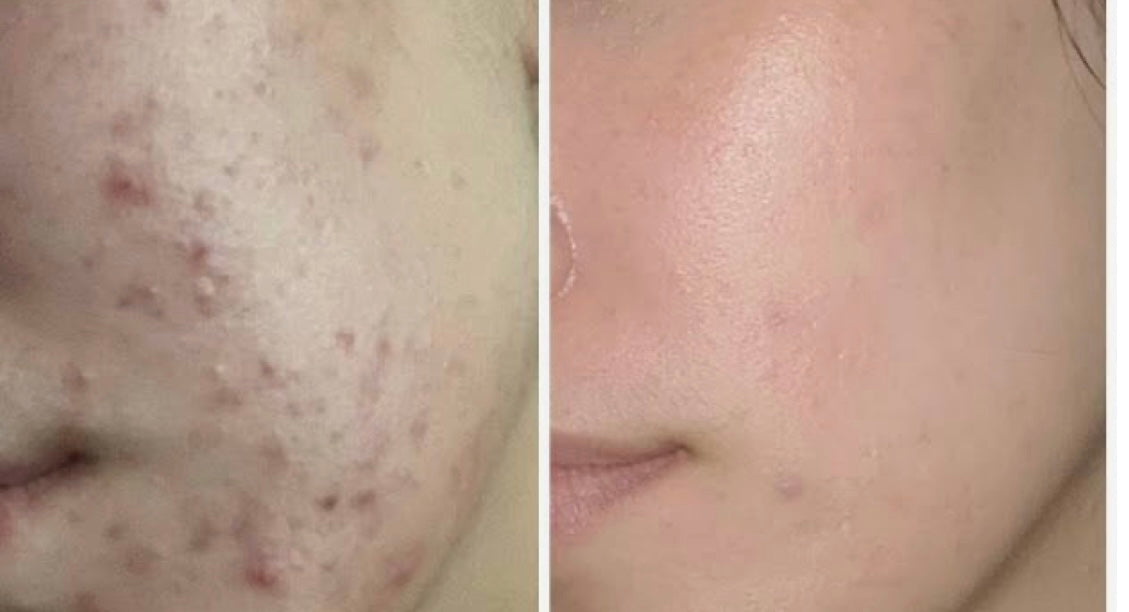 Masque Faciale LED Rajeunissement